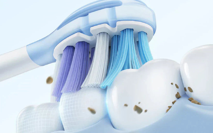White discoloration on teeth: How to remove it?